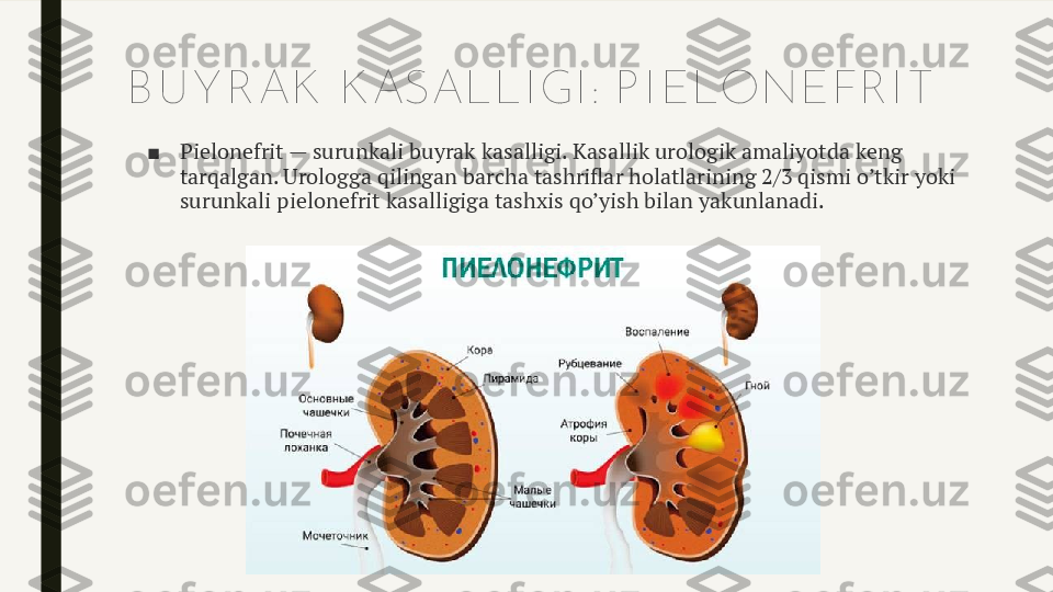 B U Y R AK  K ASALLI GI : P I ELONEFR I T
■ Pielonefrit — surunkali buyrak kasalligi. Kasallik urologik amaliyotda keng 
tarqalgan. Urologga qilingan barcha tashriflar holatlarining 2/3 qismi o’tkir yoki 
surunkali pielonefrit kasalligiga tashxis qo’yish bilan yakunlanadi. 