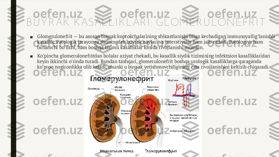 B U Y R AK  K ASALLI K LAR I : GLOM ER U LONEFR I T
■ Glomerulonefrit — bu asosan buyrak koptokchalarining shikastlanishi bilan kechadigan immunoyallig’lanishli 
kasallik. Patologik jarayonga shuningdek buyrak naylari va interstiyalar ham jalb etiladi. Patologiya ham 
birlamchi bo’lishi, ham boshqa tizimli kasalliklar fonida rivojlanishi mumkin.
■ Ko’pincha glomerulonefritdan bolalar aziyat chekadi, bu kasallik siydik tizimining infektsion kasalliklaridan 
keyin ikkinchi o’rinda turadi. Bundan tashqari, glomerulonefrit boshqa urologik kasalliklarga qaraganda 
ko’proq nogironlikka olib keladi, chunki u buyrak yetishmovchiligining erta rivojlanishini keltirib chiqaradi. 