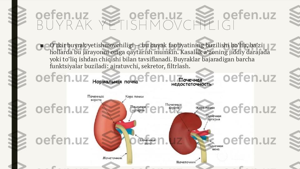 B U Y R AK  Y ETI SH M OVCH I LI GI
■ O’tkir buyrak yetishmovchiligi — bu buyak faoliyatining buzilishi bo’lib, ba’zi 
hollarda bu jarayonni ortga qaytarish mumkin. Kasallik a’zoning jiddiy darajada 
yoki to’liq ishdan chiqishi bilan tavsiflanadi. Buyraklar bajaradigan barcha 
funktsiyalar buziladi: ajratuvchi, sekretor, filtrlash. 