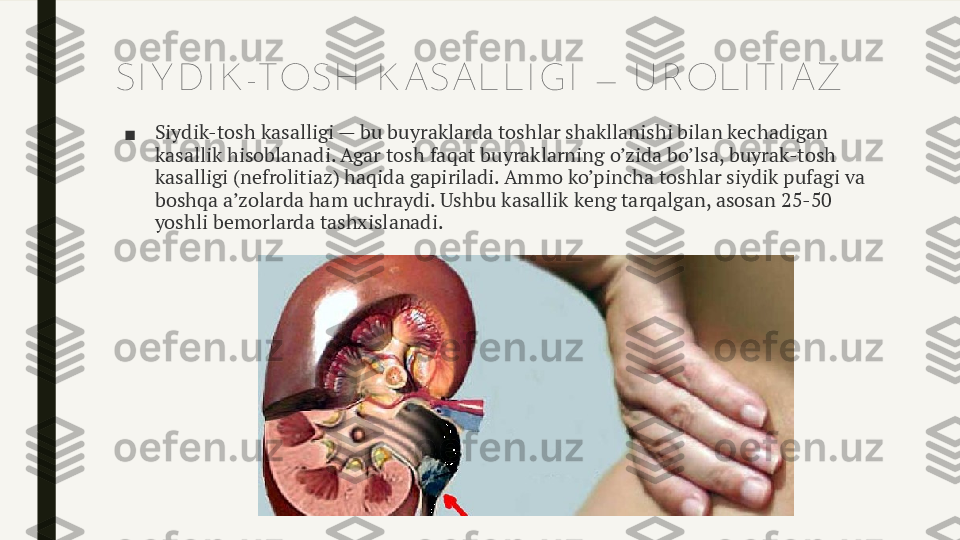 SI Y DI K -TOSH  K ASAL L I GI  — U ROL I TI AZ
■ Siydik-tosh kasalligi — bu buyraklarda toshlar shakllanishi bilan kechadigan 
kasallik hisoblanadi. Agar tosh faqat buyraklarning o’zida bo’lsa, buyrak-tosh 
kasalligi (nefrolitiaz) haqida gapiriladi. Ammo ko’pincha toshlar siydik pufagi va 
boshqa a’zolarda ham uchraydi. Ushbu kasallik keng tarqalgan, asosan 25-50 
yoshli bemorlarda tashxislanadi. 