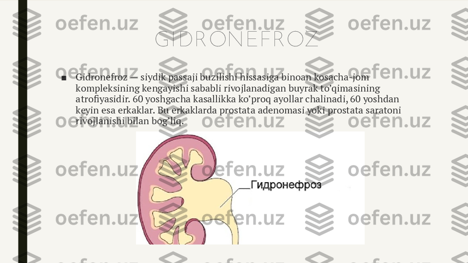 GI DRONEFROZ
■ Gidronefroz — siydik passaji buzilishi hissasiga binoan kosacha-jom 
kompleksining kengayishi sababli rivojlanadigan buyrak to’qimasining 
atrofiyasidir. 60 yoshgacha kasallikka ko’proq ayollar chalinadi, 60 yoshdan 
keyin esa erkaklar. Bu erkaklarda prostata adenomasi yoki prostata saratoni 
rivojlanishi bilan bog’liq. 