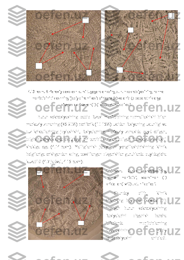 4.13-rasm. An'anaviy davolash kursi tugagandan so'ng burun sekretsiyasining normal
morfotipini tiklashning ijobiy dinamikasi: o'rtacha (a) va aniq (b   paparotniklarga
o'xshash kristallar (1) (1x40) ustunlik qiladi.
Burun   sekretsiyasining   qattiq   fazasi   morfotipining   normallashishi   bilan
markaziy zonaning (85-90%) periferik (10-15%) ustidan fasiyaning ustunligi va
tuz   kristallarining   joylashishi,   fasiyalarning   markaziy   zonasida   qayd   etilgan,
to'g'ri burchak ostida cho'zilgan 1-4 tartibli shoxlari bo'lgan "daraxtga o'xshash"
shaklga   ega   (4.14-rasm).   Yallig'lanish   jarayonini   yengillashtirishning   klinik
belgilariga   erishgandan   so'ng,   tavsiflangan   o'zgarishlar   guruhlarda   quyidagicha
kuzatildi (4.7-jadval, 4 15-rasm).
4.14-rasm.   Burun   sekretsiyasining
normal   morfotipi,   xochsimon   (1)
kristallar (1x40) ustunlik qiladi.
Shunday   qilib,   klinik
ahvolning   bayonoti   asosida   olib
borilgan   burun   sekretsiyasining
fatsiyalarini   o'rganish   barcha
holatlarda   morfotiplarning
o'zgarishining   ijobiy
tendentsiyasini   aniqladi. 