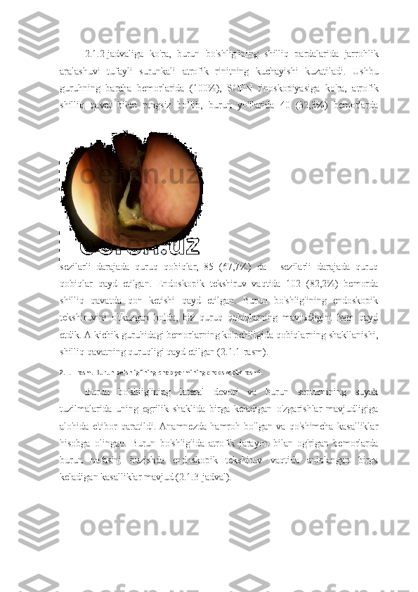 2.1.2- jadvaliga   ko ' ra ,   burun   bo ' shlig ' ining   shilliq   pardalarida   jarrohlik
aralashuvi   tufayli   surunkali   atrofik   rinitning   kuchayishi   kuzatiladi .   Ushbu
guruhning   barcha   bemorlarida   (100%),   SOPN   rinoskopiyasiga   ko ' ra ,   atrofik
shilliq   qavat   bilan   rangsiz   bo ’ lib ,   burun   yo ' llarida   40   (32,3%)   bemorlarda
sezilarli   darajada   quruq   qobiqlar ,   85   (67,7%)   da   -   sezilarli   darajada   quruq
qobiqlar   qayd   etilgan .   Endoskopik   tekshiruv   vaqtida   102   (82,2%)   bemorda
shilliq   qavatda   qon   ketishi   qayd   etilgan.   Burun   bo'shlig'ining   endoskopik
tekshiruvini   o'tkazgan   holda,   biz   quruq   qobiqlarning   mavjudligini   ham   qayd
etdik. A kichik guruhidagi bemorlarning ko'pchiligida qobiqlarning shakllanishi,
shilliq qavatning quruqligi qayd etilgan (2.1.1-rasm).
2.1.1-rasm. Burun bo'shlig'ining chap yarmining endoskopik rasmi.
Burun   bo'shlig'ining   lateral   devori   va   burun   septumining   suyak
tuzilmalarida   uning   egrilik   shaklida   birga   keladigan   o'zgarishlar   mavjudligiga
alohida   e'tibor   qaratildi.   Anamnezda   hamroh   bo'lgan   va   qo'shimcha   kasalliklar
hisobga   olingan.   Burun   bo'shlig'ida   atrofik   jarayon   bilan   og'rigan   bemorlarda
burun   nafasini   buzishda   endoskopik   tekshiruv   vaqtida   aniqlangan   birga
keladigan kasalliklar mavjud (2.1.3-jadval). 