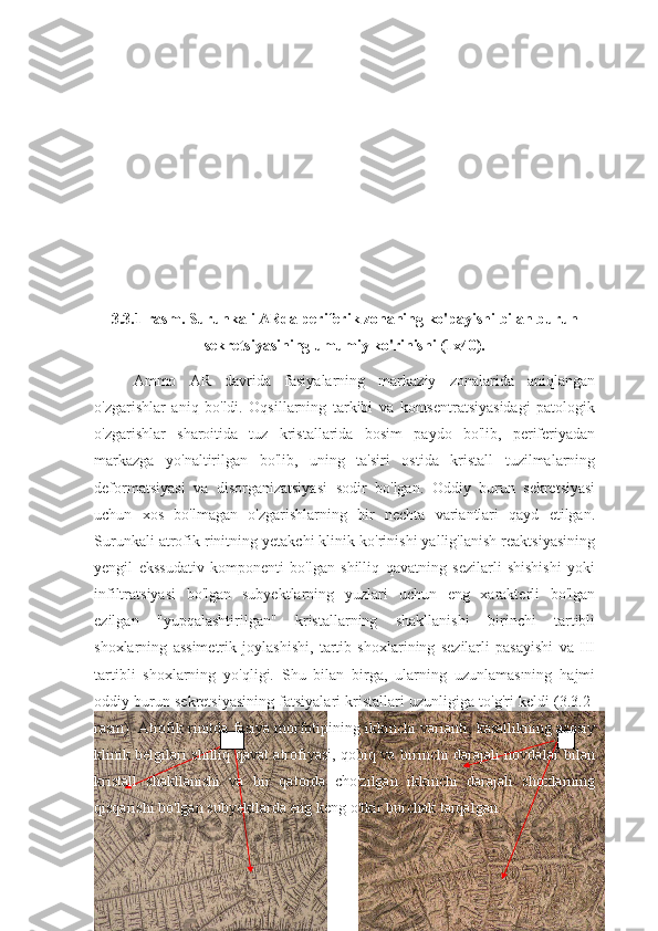 3.3.1-rasm.   Surunkali ARda periferik zonaning ko'payishi bilan burun
sekretsiyasining umumiy ko'rinishi (1x40).
Ammo   AR   davrida   fasiyalarning   markaziy   zonalarida   aniqlangan
o'zgarishlar   aniq   bo'ldi.   Oqsillarning   tarkibi   va   kontsentratsiyasidagi   patologik
o'zgarishlar   sharoitida   tuz   kristallarida   bosim   paydo   bo'lib,   periferiyadan
markazga   yo'naltirilgan   bo'lib,   uning   ta'siri   ostida   kristall   tuzilmalarning
deformatsiyasi   va   disorganizatsiyasi   sodir   bo'lgan.   Oddiy   burun   sekretsiyasi
uchun   xos   bo'lmagan   o'zgarishlarning   bir   nechta   variantlari   qayd   etilgan.
Surunkali atrofik rinitning yetakchi klinik ko'rinishi yallig'lanish reaktsiyasining
yengil   ekssudativ   komponenti   bo'lgan   shilliq   qavatning   sezilarli   shishishi   yoki
infiltratsiyasi   bo'lgan   subyektlarning   yuzlari   uchun   eng   xarakterli   bo'lgan
ezilgan   "yupqalashtirilgan"   kristallarning   shakllanishi   birinchi   tartibli
shoxlarning   assimetrik   joylashishi,   tartib   shoxlarining   sezilarli   pasayishi   va   III
tartibli   shoxlarning   yo'qligi.   Shu   bilan   birga,   ularning   uzunlamasıning   hajmi
oddiy burun sekretsiyasining fatsiyalari kristallari uzunligiga to'g'ri keldi (3.3.2-
rasm). Atrofik rinitda fasiya morfotipining ikkinchi varianti, kasallikning asosiy
klinik belgilari shilliq qavat atrofiyasi, qobiq va birinchi darajali novdalar bilan
kristall   shakllanishi   va   bir   qatorda   cho'zilgan   ikkinchi   darajali   shoxlarning
qisqarishi bo'lgan subyektlarda eng keng o'tkir burchak tarqalgan.  