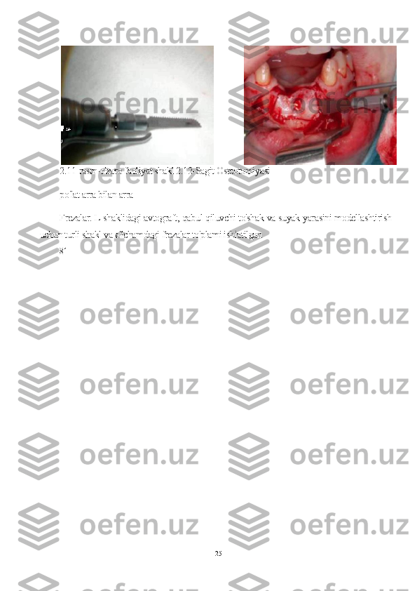 2.11-rasm-o'zaro faoliyat shakl 2.12-Sagit Osteotomiyasi-
po'lat arra bilan arra
Frezalar. L shaklidagi avtograft, qabul qiluvchi to'shak va suyak yarasini modellashtirish
uchun turli shakl va o'lchamdagi frezalar to'plami ishlatilgan 
81
25 