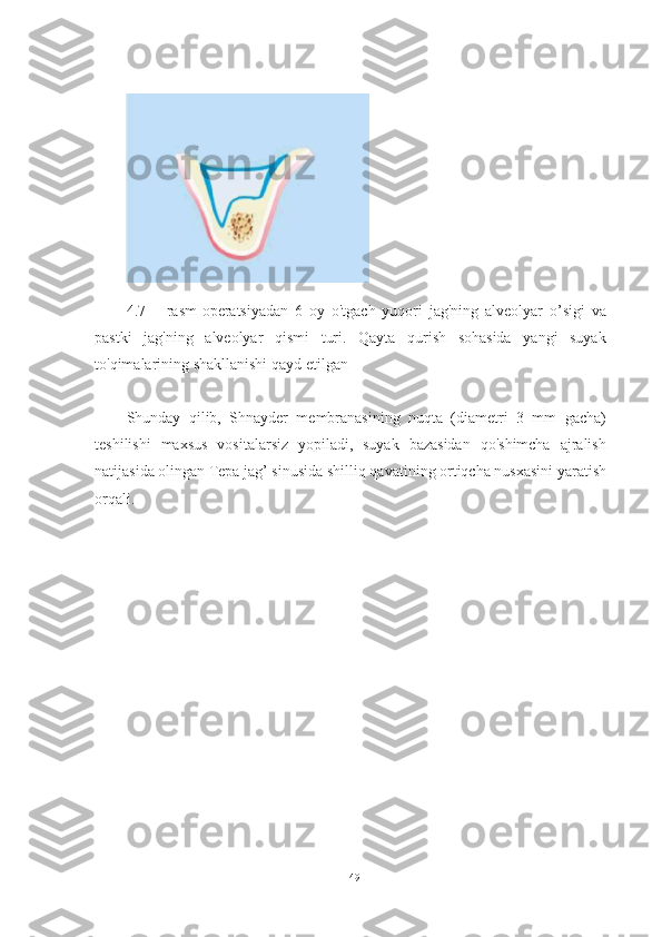 4.7   –   rasm-operatsiyadan   6   oy   o'tgach   yuqori   jag'ning   alveolyar   o’sigi   va
pastki   jag'ning   alveolyar   qismi   turi.   Qayta   qurish   sohasida   yangi   suyak
to'qimalarining shakllanishi qayd etilgan
Shunday   qilib,   Shnayder   membranasining   nuqta   (diametri   3   mm   gacha)
teshilishi   maxsus   vositalarsiz   yopiladi,   suyak   bazasidan   qo'shimcha   ajralish
natijasida olingan  Tepa jag’ sinusida  shilliq qavatining ortiqcha nusxasini yaratish
orqali.
49 