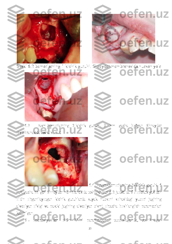 Shakl 6.2-bemorlarning 1-kichik guruhi. Shneyder membranasida nuqson yo'q
6.3   –   rasm-bemorlarning   2-kichik   guruhi.   3   mm   gacha   bo'lgan   Shnayder
membranasida teshilish turi
  6.4   –   rasm-bemorlarning   3-kichik   guruhi.   6
mm gacha bo'lgan Shneyder membranasida teshilish turi 6.2-jadvalda SL operatsiyasidan
oldin   o'rganilayotgan   kichik   guruhlarda   suyak   nuqsoni   sohasidagi   yuqori   jag'ning
alveolyar   o’sigi   va   pastki   jag'ning   alveolyar   qismi   o'rtacha   boshlang'ich   parametrlari
keltirilgan.
SL   operatsiyasidan   oldin   VHF   parametrlarini   taqqoslaganda,   teshilmagan
53 