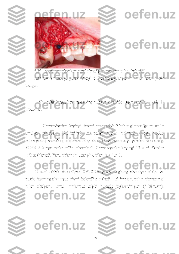 6.26 – rasm-osteoplastik material o'rnatilgan implantni to'liq o'rab oladi 
6.27-rasm-operatsiya   yarasi   Vicryl   5-0   rezorbsiyalangan   ip   bilan   tarangliksiz
tikilgan
    Shu bilan birga, bemorga oxirgi nuqson sohasida o'ng tomonda LFDA Di
o'tkazildi.
          Operatsiyadan   keyingi   davrni   boshqarish   2-bobdagi   tavsifga   muvofiq
amalga   oshiriladi   (2.6-bo'lim).   Asoratlar   paydo   bo'lmadi.   O'ng   bukkal
mintaqaning yumshoq to'qimalarining shishishi  va operatsiya yaralari sohasidagi
SOPR   7   kunga   qadar   to'liq   to'xtatiladi.   Operatsiyadan   keyingi   12-kuni   tikuvlar
olib tashlanadi. Yara birlamchi taranglik bilan davolandi.
12-kuni   ishlab   chiqarilgan   OPTGDA   yuqori   jag'ning   alveolyar   o’sigi   va
pastki   jag'ning   alveolyar   qismi   balandligi   oshadi,   1.6   implant   to'liq   biomaterial
bilan   o'ralgan,   dental   implantlar   to'g'ri   holatda   joylashtirilgan   (6.28-rasm).
70   