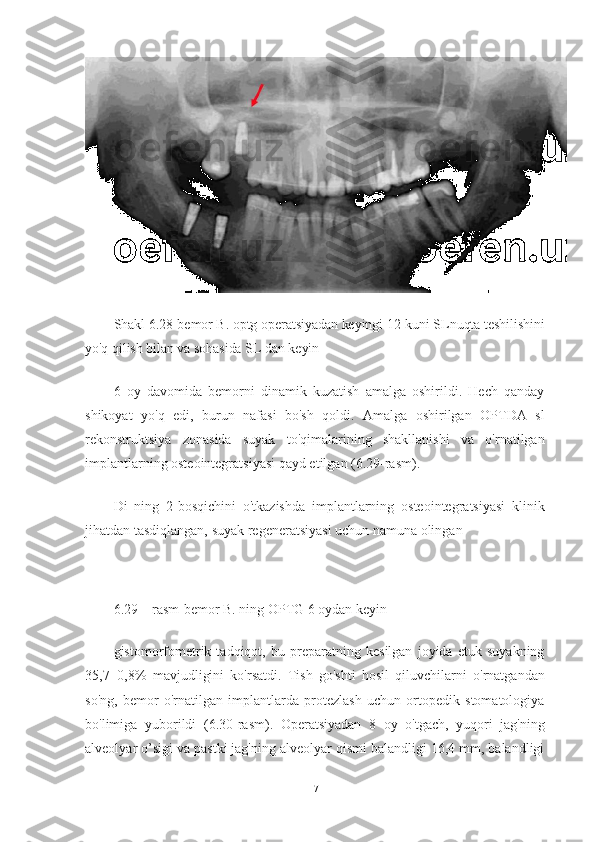 Shakl 6.28-bemor B. optg operatsiyadan keyingi 12-kuni SLnuqta teshilishini
yo'q qilish bilan va sohasida SL dan keyin
6   oy   davomida   bemorni   dinamik   kuzatish   amalga   oshirildi.   Hech   qanday
shikoyat   yo'q   edi,   burun   nafasi   bo'sh   qoldi.   Amalga   oshirilgan   OPTDA   sl
rekonstruktsiya   zonasida   suyak   to'qimalarining   shakllanishi   va   o'rnatilgan
implantlarning osteointegratsiyasi qayd etilgan (6.29-rasm).
Di   ning   2-bosqichini   o'tkazishda   implantlarning   osteointegratsiyasi   klinik
jihatdan tasdiqlangan, suyak regeneratsiyasi uchun namuna olingan 
 
6.29 – rasm-bemor B. ning OPTG 6 oydan keyin
gistomorfometrik   tadqiqot,   bu   preparatning   kesilgan   joyida   etuk   suyakning
35,7±0,8%   mavjudligini   ko'rsatdi.   Tish   go'shti   hosil   qiluvchilarni   o'rnatgandan
so'ng,   bemor   o'rnatilgan   implantlarda   protezlash   uchun   ortopedik   stomatologiya
bo'limiga   yuborildi   (6.30-rasm).   Operatsiyadan   8   oy   o'tgach,   yuqori   jag'ning
alveolyar o’sigi va pastki jag'ning alveolyar qismi balandligi 16,4 mm, balandligi
71 