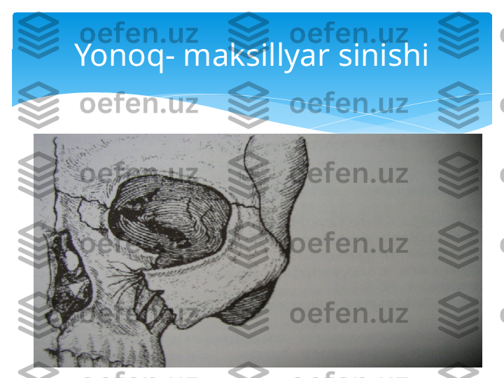 Yonoq- maksillyar sinishi   