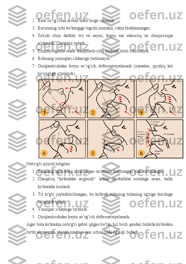 2. Bola so’rg’ichni	 areola	 bilan	 birga	 ushlaydi.
3. Burunning	
 uchi	 ko'kragiga	 tegishi	 mumkin,	 lekin	 bloklanmagan.
4. So'rish	
 ritmi	 dastlab	 tez	 va	 sayoz,	 keyin	 esa	 sekinroq	 va	 chuqurroqqa
o'zgaradi.	
  Chaqaloq	 yutadi.
5. Emizayotganda	
 onasi	 shalpillash	 yoki	 hushtak	 otish	 eshitmaydi.
6. Bolaning	
 yonoqlari	 ichkariga	 tortilmaydi.
7. Oziqlantirishdan	
 keyin	 so’rg’ich	 deformatsiyalanadi	 (masalan,	 qiyshiq	 lab
bo'yog'iga	
 o'xshaydi).
Noto'g'ri	
 qoyish	 belgilari:
1. Bolaning
 og'zi	 keng	 ochilmagan	 va	 lablari	 burilmagan	 yoki	 tortilmagan.
2. Chaqaloq	
 "ko'krakka	 sirg'andi":	 lablar	 va	 milklar	 areolaga	 emas,	 balki
ko'krakka	
 bosiladi.
3. Til	
 to'g'ri	 joylashtirilmagan,	 bu	 ko'krak	 uchining	 bolaning	 og'ziga	 kirishiga
to'sqinlik	
 qiladi.
4. Yonoqlar
 ichkariga	 tortiladi.
5. Oziqlantirishdan	
 keyin	 so’rg’ich	 deformatsiyalanadi.
Agar	
 bola	 ko'krakni	 noto'g'ri	 qabul	 qilgan	 bo'lsa,	 biz	 hech	 qanday	 holatda	 ko'krakni
tortib	
 olmaymiz,	 chunki	 muolaja	 ona	 uchun	 juda	 og'riqli	 bo'ladi. 