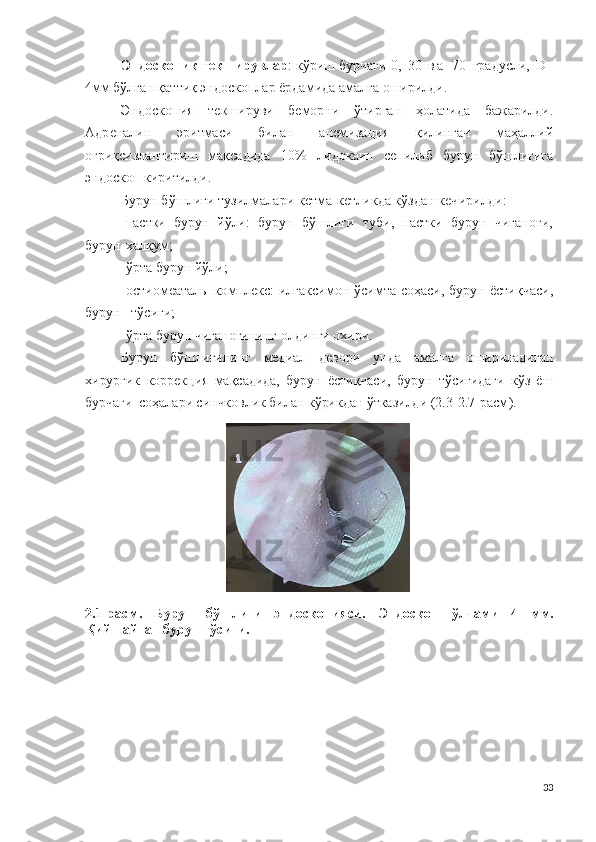 Эн до с к о п ик текширувлар : кўриш бурчаги   0 ,   3 0   в а   7 0   г р а д у сли,   D -
4мм бўлган қаттиқ эндоскоплар ёрдамида амалга оширилди.
Эн д о с к о пи я   текшируви   беморни   ўтирган   ҳолатида   бажарилди.
А д р е н али н   эритмаси   билан   а н ем и зац и я   қилингач   маҳаллий
оғриқсизлантириш   мақсадида   10 %   л и д о к а ин   сепилиб   бурун   бўшлиғига
эндос к о п киритилди.
Бурун бўшлиғи тузилмалари кетма-кетликда кўздан кечирилди :
-пастки   бурун   йўли :   бурун   бўшлиғи   туби,   пастки   бурун   чиғаноғи,
бурун-халқум ;
-ўрта бурун йўли ;
-о с т ио меата ль   к о м п л е кс:  илгаксимон  ўсимта  соҳаси,  бурун  ёстиқчаси,
бурун   тўсиғи;
-ўрта бурун чиғаноғининг олдинги охири.
Бурун   бўшлиғининг   медиал   девори   унда   амалга   ошириладиган
хирургик   коррекция   мақсадида,   бурун   ёстиқчаси,   бурун   тўсиғидаги   кўз   ёш
бурчаги  соҳалари синчковлик билан кўрикдан ўтказилди   ( 2 . 3 - 2 . 7-расм ).
                              
2. 1-расм .   Бурун   бўшлиғи   э н д о с к о п и яси.   Эн д о с к о п   ўлчами   4   м м.
Қийшайган бурун тўсиғи. 
33 