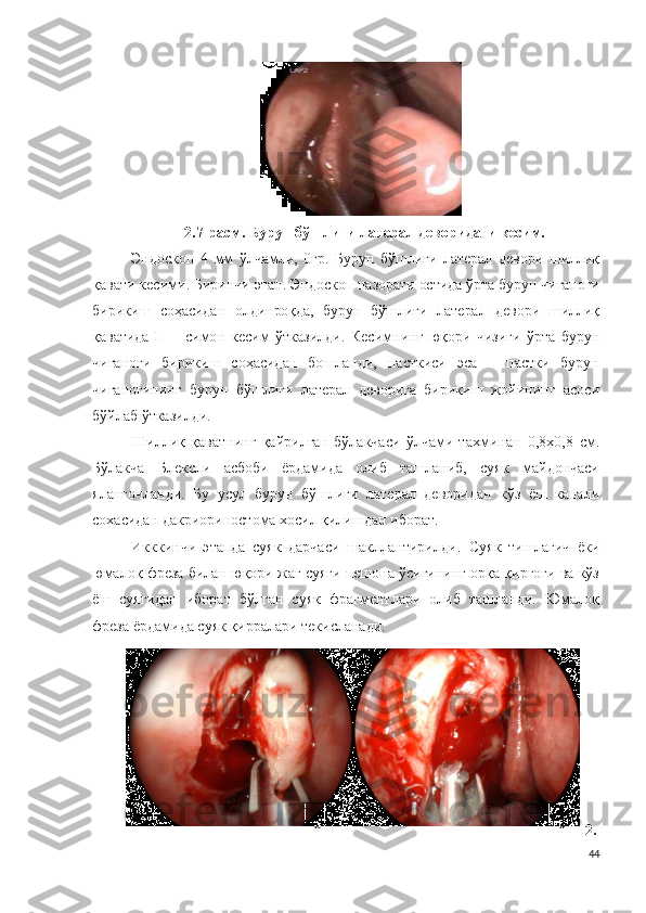 2.7 -расм .  Бурун бўшлиғи  латерал девори даги кесим .
Э н до ск оп   4   м м   ўлчамли,   0гр.   Бурун   бўшлиғи   латерал   девори   шиллиқ
қавати кесими. Биринчи этап.  Эндоскоп назорати остида ўрта бурун чиғаноғи
бирикиш   соҳасидан   олдинроқда,   бурун   бўшлиғи   латерал   девори   шиллиқ
қаватида   П   –   симон   кесим   ўтказилди.   Кесимнинг   юқори   чизиғи   ўрта   бурун
чиғаноғи   бирикиш   соҳасидан   бошланди,   пасткиси   эса   –   пастки   бурун
чиғаноғининг   бурун   бўшлиғи   латерал   деворига   бирикиш   жойининг   асоси
бўйлаб ўтказилди.
Шиллиқ   қаватнинг   қайрилган   бўлакчаси   ўлчами   тахминан   0 , 8 х0 , 8   см.
Бўлакча   Бл ексли   асбоби   ёрдамида   олиб   ташланиб,   суяк   майдончаси
яланғочланди.   Бу   усул   бурун   бўшлиғи   латерал   деворидан   кўз   ёш   канали
сохасидан дакриориностома хосил қилишдан иборат.
Икккинчи   э т а пда   суяк   дарчаси   шакллантирилди .   Суяк   тишлагич   ёки
юмалоқ фреза билан юқори жағ суяги пешона ўсиғининг орқа қирғоғи ва кўз
ёш   суягидан   иборат   бўлган   суяк   фрагментлари   олиб   ташланди.   Юмалоқ
фреза ёрдамида суяк қирралари текисланади.
2.
44       а   б   