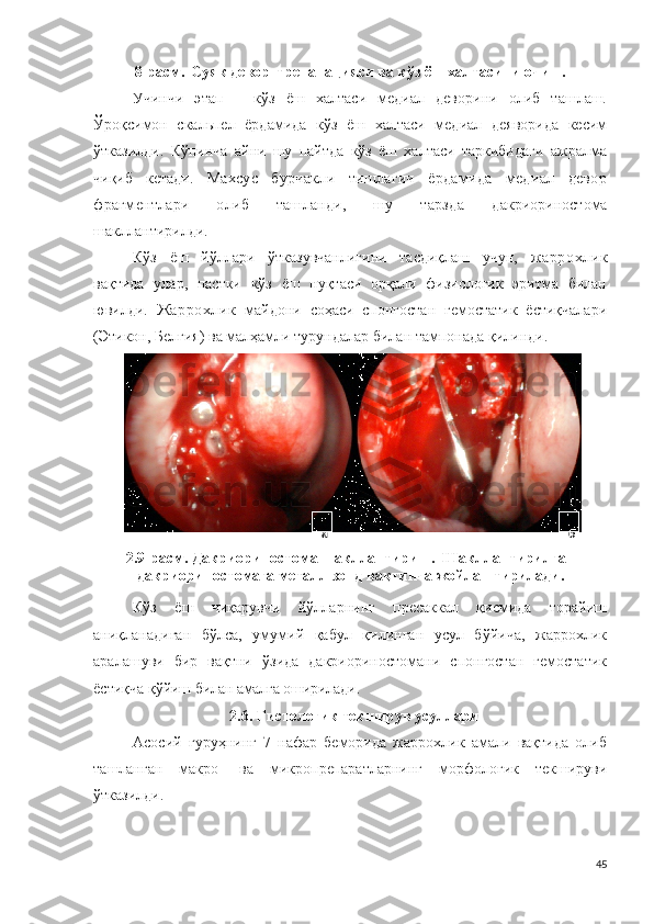 8-расм.   Суяк девор   тр е п а н ац и яси ва кўз ёш халтасини очиш.
Учинчи   э т а п   –   кўз   ёш   халтаси   медиал   деворини   олиб   ташлаш.
Ўроқсимон   скальпел   ёрдамида   кўз   ёш   халтаси   медиал   деяворида   кесим
ўтказилди.   Кўпинча   айни   шу   пайтда   кўз   ёш   халтаси   таркибидаги   ажралма
чиқиб   кетади.   Махсус   бурчакли   тишлагич   ёрдамида   медиал   девор
фрагментлари   олиб   ташланди,   шу   тарзда   д а к р ио р и н о ст о м а
шакллантирилди . 
Кўз   ёш   йўллари   ўтказувчанлигини   тасдиқлаш   учун,   жаррохлик
вақтида   улар,   пастки   кўз   ёш   нуқтаси   орқали   физиологик   эритма   билан
ювилди.   Жаррохлик   майдони   соҳаси   спонгостан   гемостатик   ёстиқчалари
(Этикон, Белгия) ва малҳамли турундалар билан тампонада қилинди .
2.9 -расм .  Д а к р и ор и н о с то ма шакллантириш .   Шакллантирилган
д а к р и ор и н о с то ма га металл зонд вақтинча жойлаштирилади.
Кўз   ёш   чиқарувчи   йўлларнинг   пресаккал   қисмида   торайиш
аниқланадиган   бўлса,   умумий   қабул   қилинган   усул   бўйича,   жаррохлик
аралашуви   бир   вақтни   ўзида   дакриориностомани   спонгостан   гемостатик
ёстиқча қўйиш  билан амалга оширилади
.
2.6. Ги с т о ло г ик текширув усуллари
Асосий   гуруҳнинг   7   нафар   беморида   жаррохлик   амали   вақтида   олиб
ташланган   макро-   ва   микропрепаратларнинг   морфологик   текшируви
ўтказилди.
45        а   б   