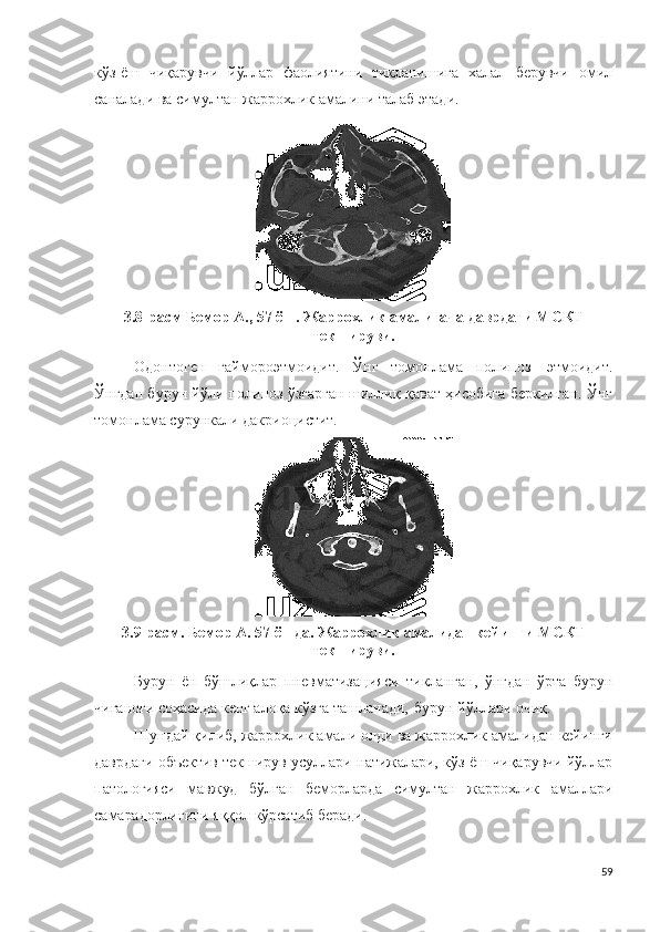 кўз-ёш   чиқарувчи   йўллар   фаолиятини   тикланишиг а   халал   берувчи   омил
саналади ва с и м у л тан   жаррохлик  амали н и талаб этади .
3.8 -расм   Б емор  А., 57  ёш .  Жаррохлик  амалигача  даврдаги  М С КТ
текшируви .
Одо н тог е н   г а й м ороэ т м о и д и т .   Ўнг   томонлама   пол ип о з   э т м о и д и т.
Ўнгдан бурун йўли полипоз ўзгарган шиллиқ қават ҳисобига беркилган. Ўнг
томонлама сурункали дакриоцистит.
3.9 -расм .  Б емор  А. 5 7   ёшда .  Жаррохлик  амали дан  кейинги  М С КТ
текшируви .
Бурун   ён   бўшлиқлар   пн е в ма т изацияси   тикланган ,   ўнгдан   ўрта   бурун
чиғаноғи соҳасида кенг алоқа кўзга ташланади,   бурун йўллари очиқ.
Шундай қилиб, жаррохлик амали олди ва жаррохлик амалидан кейинги
даврдаги объектив текширув усуллари натижалари, кўз-ёш чиқарувчи йўллар
патологияси   мавжуд   бўлган   беморларда   симултан   жаррохлик   амаллари
самарадорлигини яққол кўрсатиб беради .
59 