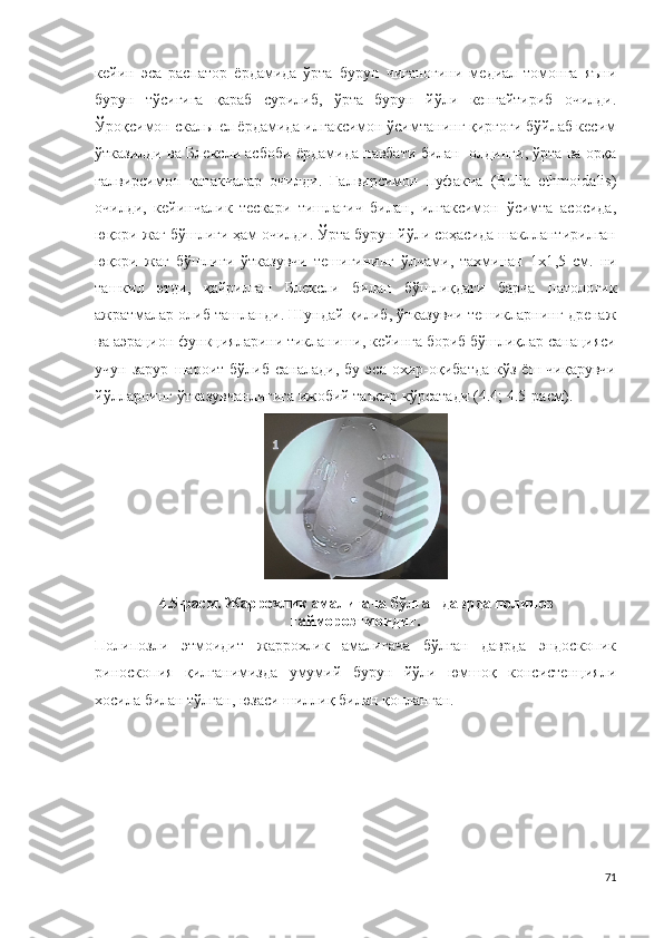 кейин   эса   распатор   ёрдамида   ўрта   бурун   чиғаноғини   медиал   томонга   яъни
бурун   тўсиғига   қараб   сурилиб,   ўрта   бурун   йўли   кенгайтириб   очилди .
Ўроқсимон скальпел ёрдамида илгаксимон ўсимтанинг қирғоғи бўйлаб кесим
ўтказилди ва Б л е кс л и асбоби ёрдамида навбати билан   олдинги, ўрта ва орқа
ғалвирсимон   катакчалар   очилди.   Ғалвирсимон   пуфакча   ( B u l l a   e th m oid a l i s )
очилди,   кейинчалик   тескари   тишлагич   билан,   илгаксимон   ўсимта   асосида,
юқори жағ бўшлиғи ҳам очилди. Ўрта бурун йўли соҳасида шакллантирилган
юқори   жағ   бўшлиғи   ўтказувчи   тешигининг   ўлчами,   тахминан   1 х1 ,5   с м.   ни
ташкил   этди,   қайрилган   Б л ексли   билан   бўшлиқдаги   барча   пат о л о г ик
ажратмалар олиб ташланди . Шундай қилиб, ўтказувчи тешикларнинг дренаж
ва аэрацион функцияларини тикланиши, кейинга бориб бўшлиқлар санацияси
учун   зарур   шароит  бўлиб   саналади,   бу   эса   охир-оқибатда   кўз  ёш   чиқарувчи
йўлларнинг ўтказувчанлигига ижобий таъсир кўрсатади   (4 . 4 ;   4 . 5-расм ).
4.5-расм.  Жаррохлик амали гача бўлган даврда пол ип о з
г а й м ороэ т м о и д и т.
Полипозли   этмоидит   жаррохлик   амали гача   бўлган   даврда   эндоскопик
риноскопия   қилганимизда   умумий   бурун   йўли   юмшоқ   консистенцияли
хосила билан тўлган, юзаси шиллиқ билан қопланган.
71 