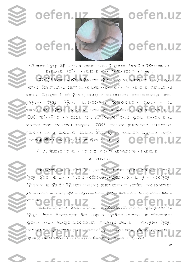 4.6 -расм .  Бурун  бўшлиғи э н до с к о пи я си . Э н до с к о п   4 м м   0гр.   Жаррохлик
амали дан кейинги даврда  пол ип о з  г а й м ороэ т м о и д и т.
Э Э ДЦР   босқичи   айтиб   ўтилган   кўринишдагидек   амалга   оширилади .
Барча   беморларда   жаррохлик   амали дан   кейинги   давр   асоратларсиз
кечди.   Орадан   6   ой   ўтгач,   назорат   эндоскопик   риноскопияда   кенг
умумий   бурун   йўли,   ғалвирсимон   катакчаларни   очилиши   ва
аҳамиятсиз   бўлган   чандиқли-битишма   жараёнини   кузатиш   мумкин,
ЮЖБ  табиий  тешиги  сақланган,     7 0 ° эндос к о п билан кўздан кечирилганда
клиник   симптомларсиз   кечувчи,   ЮЖБ   шиллиқ   қаватининг   сезиларсиз
реактив   шиши   сақланиб   қолади .   Ўрта   бурун   чиғаноғи   олдинги   охири
соҳасида тўлақонли   д а к рио ст о ма кўзга ташланади.
4.1.4. В а з о м о т о р  ва  г ип ер т р о ф и к  р и ни т да жарроҳлик даволаш
натижалари
Ва з о м о т о р   ва   г и п е р т р о ф ик   рин и тда   пастки   бурун   чиғаноғи   остида
бурун кўз ёш каналининг механик босилиши кузатилади ва шунингдек бурун
бўшлиғи   ва   кўз   ёш   йўллари   шиллиқ   қаватларининг   морфологик   жиҳатдан
ўхшашлиги   сабабли,   кўз   ёш   йўлларининг   ўзида   ҳам   шиш   ва  торайиш   юзага
келади.
Вазомотор ринит билан оғриган 12 нафар бемор бизнинг кузатувимизда
бўлди.   Барча   беморларга   бир   лаҳзали   т у рби н оп л а сти к а   ва   айрисимон
кўринишидаги   махсус   электродлар   ёрдамида   амалга   оширилувчи   бурун
чиғаноқлари   дезинтеграцияси   қилиниб,   улар   чиғаноқни   тубига   киритилади.
Бу жаррохлик амали  УТТ   а п п а р а т и ёрдамида амалга оширилди .
72 