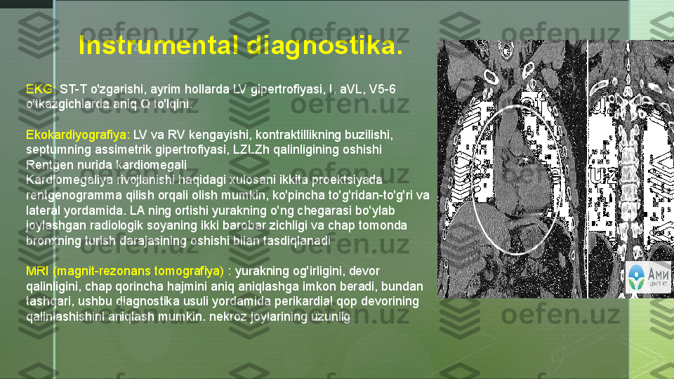 z
Instrumental diagnostika .
EKG:  ST-T o'zgarishi, ayrim hollarda LV gipertrofiyasi, I, aVL, V5-6 
o'tkazgichlarda aniq Q to'lqini.
Ekokardiyografiya:  LV va RV kengayishi, kontraktillikning buzilishi, 
septumning assimetrik gipertrofiyasi, LZLZh qalinligining oshishi
Rentgen nurida kardiomegali
Kardiomegaliya rivojlanishi haqidagi xulosani ikkita proektsiyada 
rentgenogramma qilish orqali olish mumkin, ko'pincha to'g'ridan-to'g'ri va 
lateral yordamida. LA ning ortishi yurakning o'ng chegarasi bo'ylab 
joylashgan radiologik soyaning ikki barobar zichligi va chap tomonda 
bronxning turish darajasining oshishi bilan tasdiqlanadi
MRI (magnit-rezonans tomografiya) :  yurakning og'irligini, devor 
qalinligini, chap qorincha hajmini aniq aniqlashga imkon beradi, bundan 
tashqari, ushbu diagnostika usuli yordamida perikardial qop devorining 
qalinlashishini aniqlash mumkin. nekroz joylarining uzunlig  