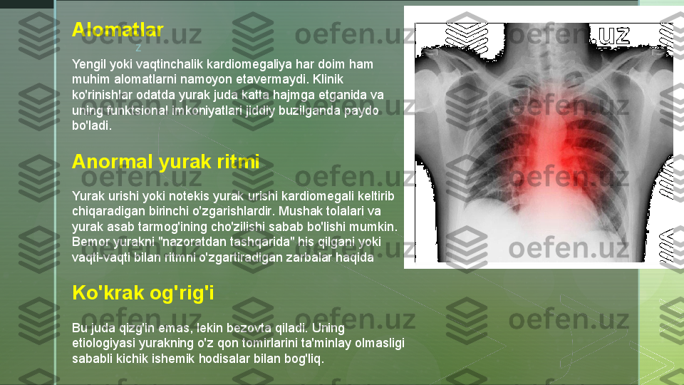 zAlomatlar
Yengil yoki vaqtinchalik kardiomegaliya har doim ham 
muhim alomatlarni namoyon etavermaydi. Klinik 
ko'rinishlar odatda yurak juda katta hajmga etganida va 
uning funktsional imkoniyatlari jiddiy buzilganda paydo 
bo'ladi.
Anormal yurak ritmi
Yurak urishi yoki notekis yurak urishi kardiomegali keltirib 
chiqaradigan birinchi o'zgarishlardir. Mushak tolalari va 
yurak asab tarmog'ining cho'zilishi sabab bo'lishi mumkin. 
Bemor yurakni "nazoratdan tashqarida" his qilgani yoki 
vaqti-vaqti bilan ritmni o'zgartiradigan zarbalar haqida
Ko'krak og'rig'i
Bu juda qizg'in emas, lekin bezovta qiladi. Uning 
etiologiyasi yurakning o'z qon tomirlarini ta'minlay olmasligi 
sababli kichik ishemik hodisalar bilan bog'liq.  