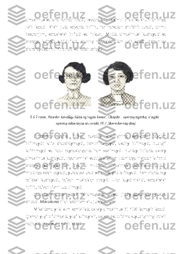 almashinuv va tana harorati ortadi, ovqatni ko’p iste’mol qiladi va shu bilan birga
ozib   ketadi.   Kishi   juda   serzarda   bo’lib,   har   narsadan   cho’chib   turadi,   doimo
besaranjom,   sertashvish   bo’ladi   va   hokazo.   Modda   almashinuvi   kuchayadi   va
energiya   ko’proq   sarf   bo’ladi,   shuning   natijasida   odam   ozib   ketadi.   Bemor   tez
charchaydigan bo’lib qoladi va hadeb terlaydi .
9.6.2-rasm. Bazedov kasalligi bilan og’rigan bemor. Chapda – operasiyagacha, o’ngda –
operasiyadan keyin tez orada (N.A.Shereshevskiydan)
Gipertireoz   ozgina   bo’lsa   Bazedov   kasalligining   xarakterli   belgilari
bo’lmaydi:   ko’z   chaqchaymaydi,   bemor   ozmaydi,   asabiy   bo’lmaydi,   buqog’i
ko’rinmaydi   va   hatto   paypaslanganda   ham   sezilmaydi.   Bunday   hollarda   asosiy
almashinuv kuchayadi, organizm ish vaqtida sog’lom odamlarga nisbatan ko’proq
energiya   sarflaydi,   dam   olganda   moddalar   almashinuvi   tinchlik   holatidagi
miqdorga sekin qaytadi, yurak tez uradi va qonda yod ko’payadi. Bemorlarda pay
refleksi   kuchayadi,   ba’zan   mushaklar   titraydi.   Ular   kuydi-pishdi,   sertashvish
bo’lib, ba’zan o’zini tuta olmaydi.
Qalqonsimon   bez   yetarli   ishlamaganda   g’oyat   jiddiy   kasalliklar   yuzaga
chiqadi.  Miksidema  bilan kretinizm shu jumladandir. 
Miksidema yoki xom semizlikda asosiy almashinuv 30-40% kamayib ketadi.
Qisman yog’ to’qimasida yog’ ko’payishi, asosan esa to’qima suyuqligining ortishi
natijasida tana vazni oshib ketadi. 