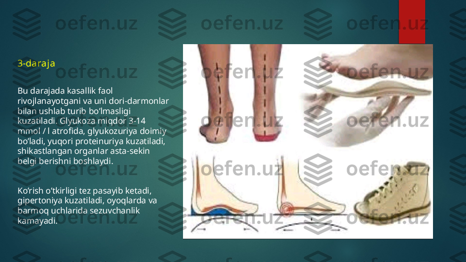 3-daraja
Bu darajada kasallik faol 
rivojlanayotgani va uni dori-darmonlar 
bilan ushlab turib bo’lmasligi 
kuzatiladi. Glyukoza miqdor 3-14 
mmol / l atrofida, glyukozuriya doimiy 
bo’ladi, yuqori proteinuriya kuzatiladi, 
shikastlangan organlar asta-sekin 
belgi berishni boshlaydi.
Ko’rish o’tkirligi tez pasayib ketadi, 
gipertoniya kuzatiladi, oyoqlarda va 
barmoq uchlarida sezuvchanlik 
kamayadi.   